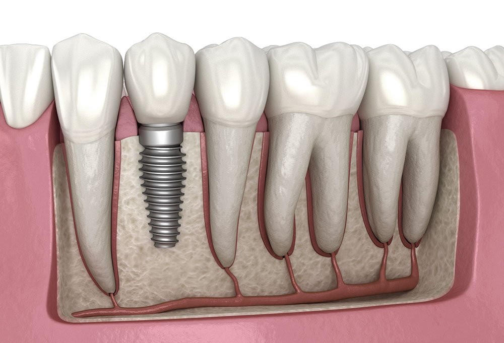 Smile Care Dental root canal