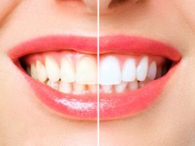 Smile Care Dental teeth whitening