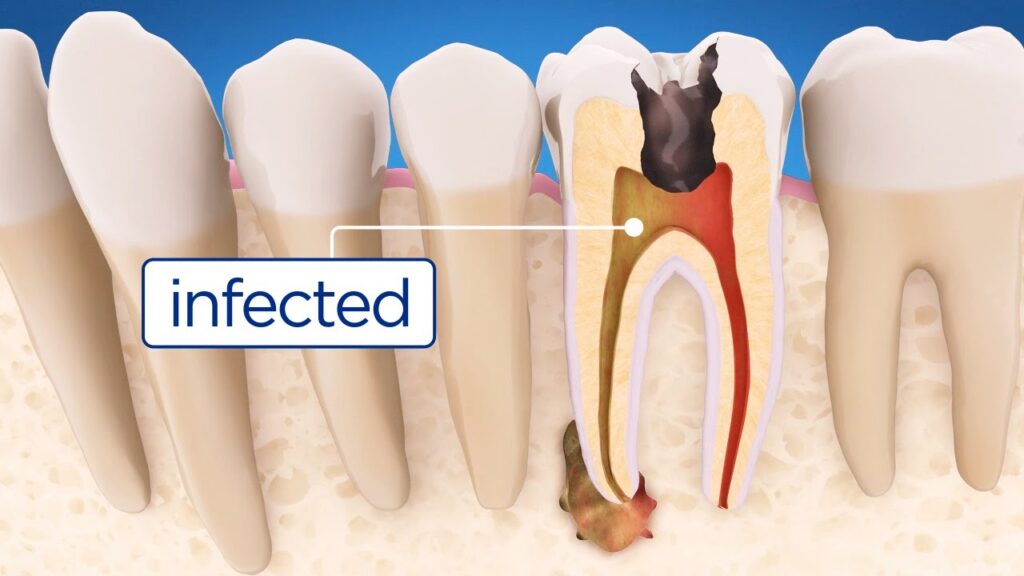 Smile Care Dental infected tooth