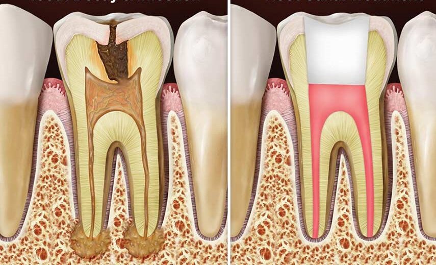 Smile Care Dental root canal treatment