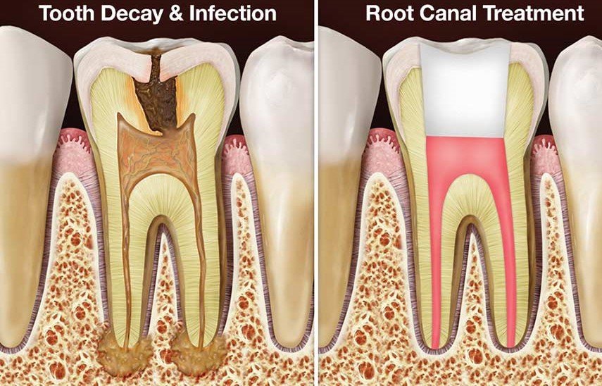 Smile Care Dental root canal treatment