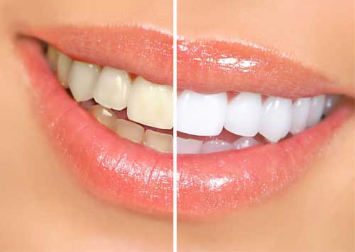 Smile Care Dental teeth whitening