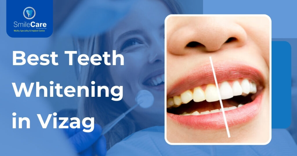 Best Teeth Whitening in Vizag