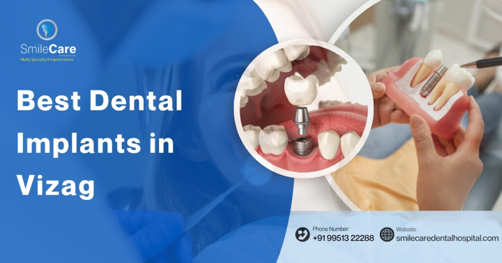 Best Dental Implants in Vizag