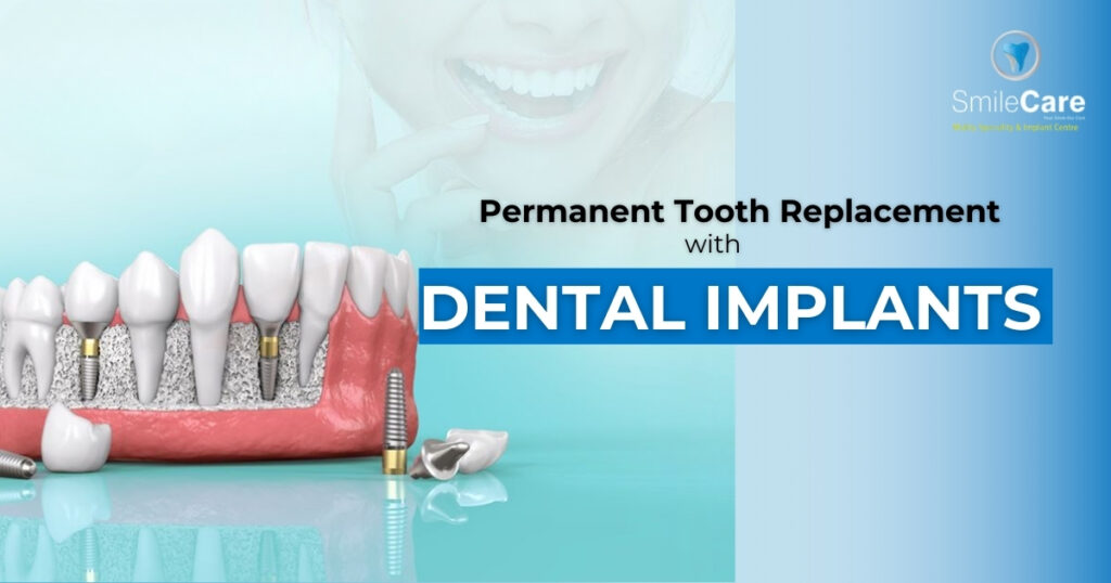 best dental implants in Vizag