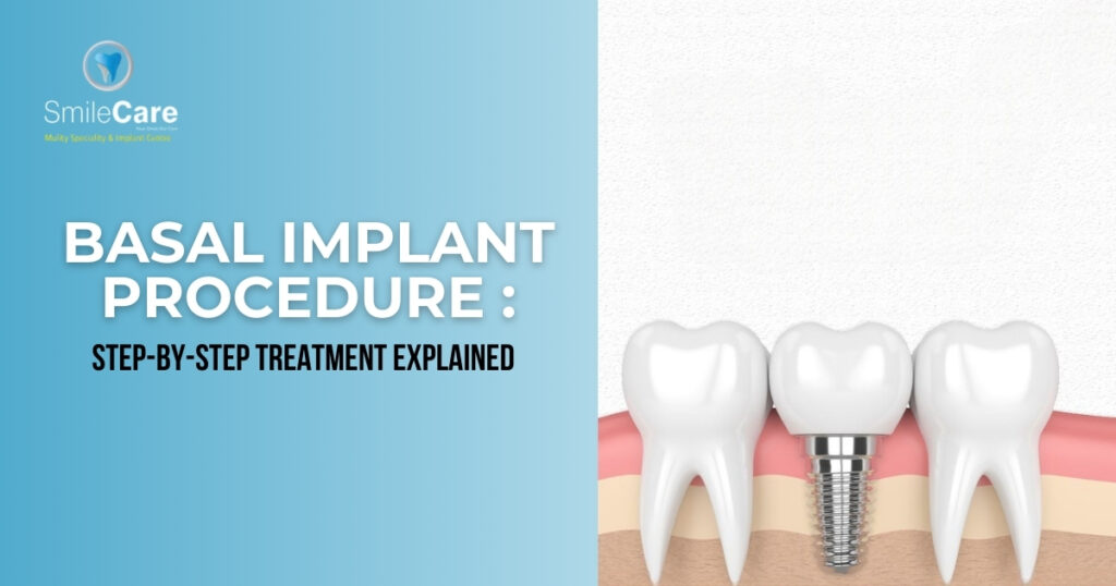 basal implants in vizag