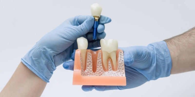 Dental implants in Vizag