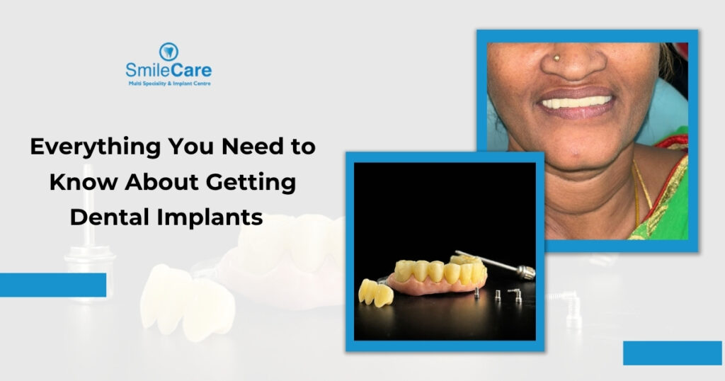 best dental implants in vizag