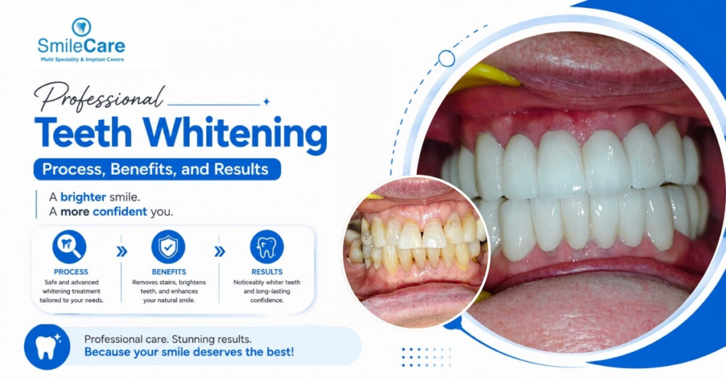 Teeth whitening in Vizag