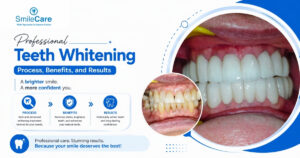 Teeth whitening in Vizag