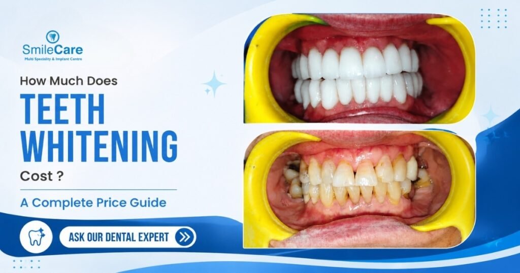 Teeth whitening in Vizag