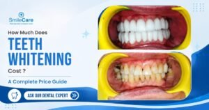 Teeth whitening in Vizag