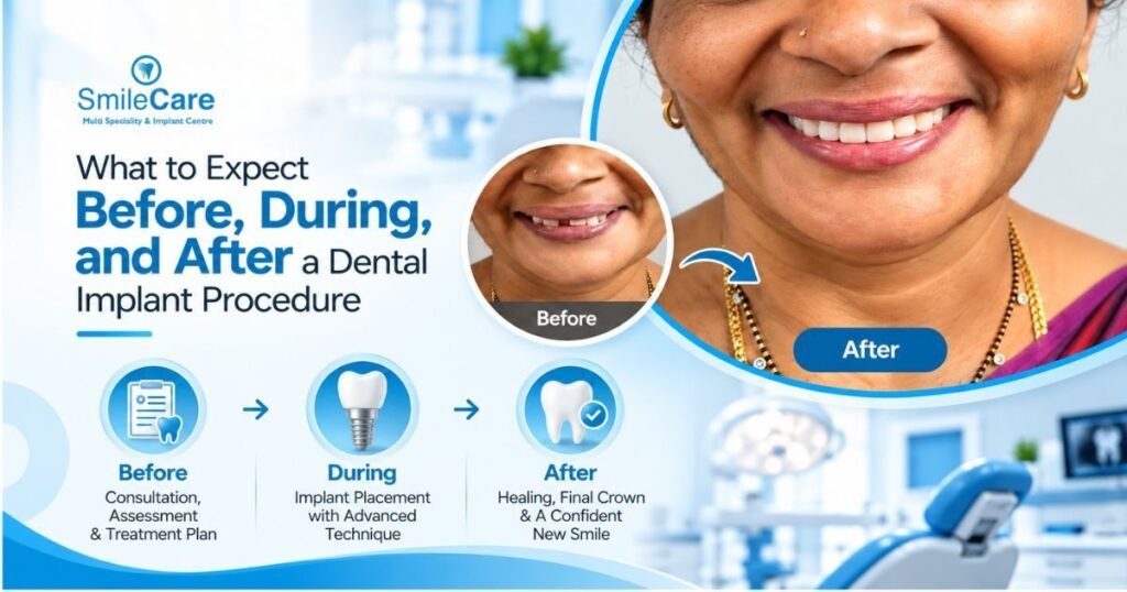 Dental Implants in Vizag